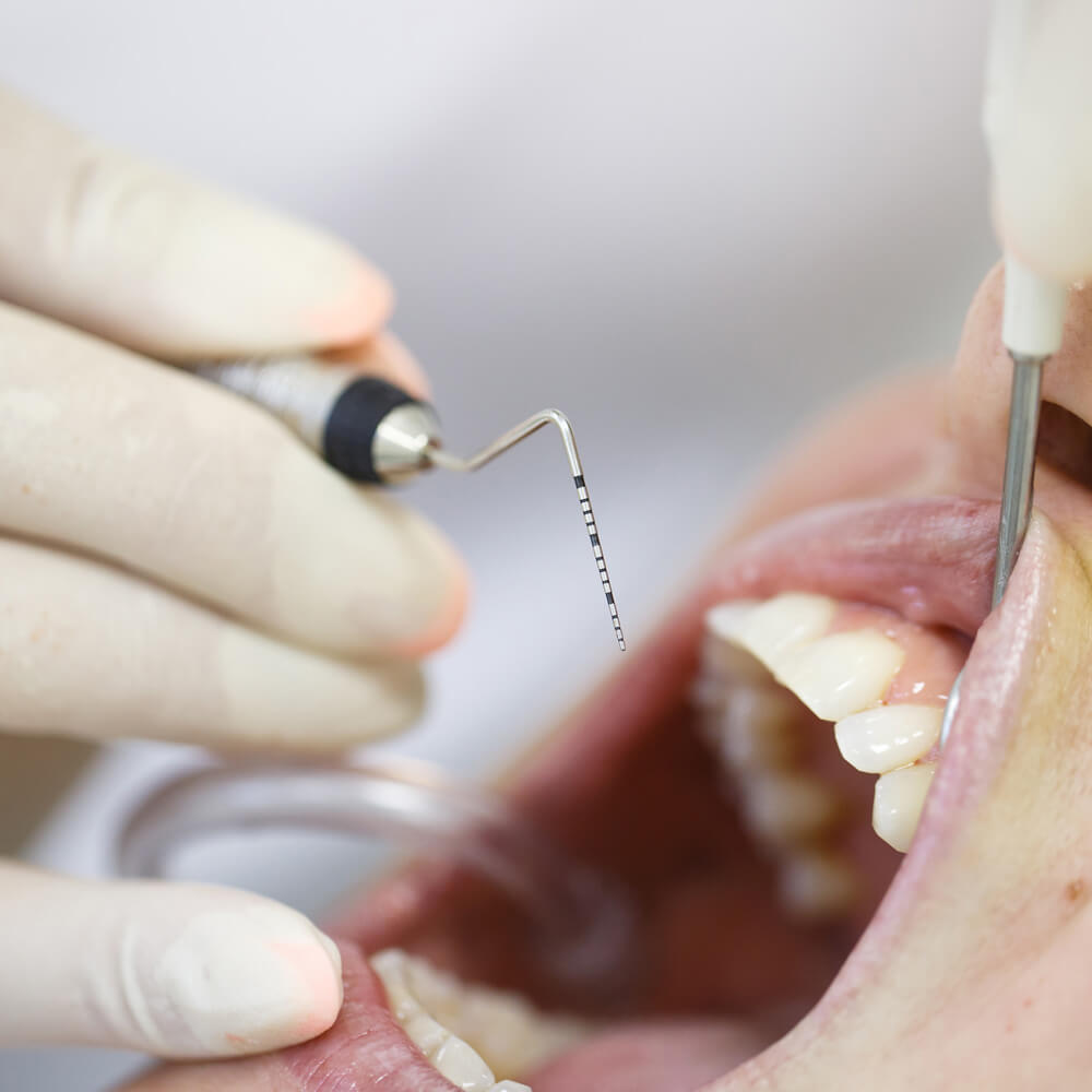 Fogászati kezeléseink: fogágybetegség, fogínygyulladás - Novum Dental