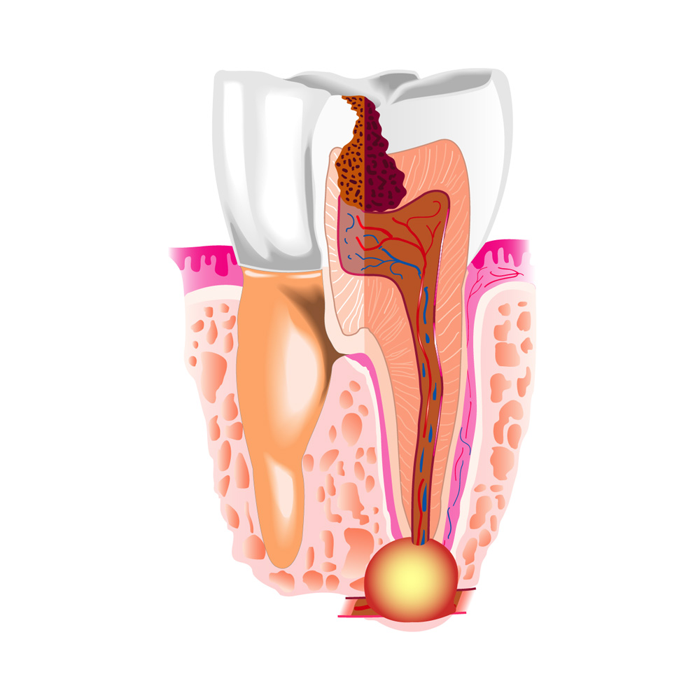 Gyökérkezelés - Fogászat és szájsebészet - Novum Dental